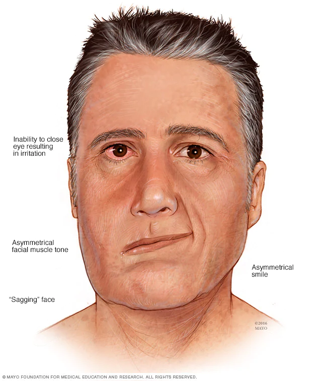 Ramsay Hunt syndrome (RHS)