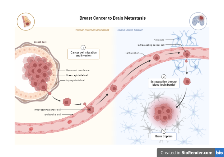  Metastasis of breast cancer