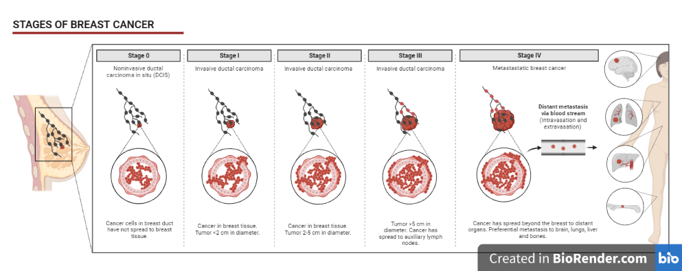 Stages of breast cancer