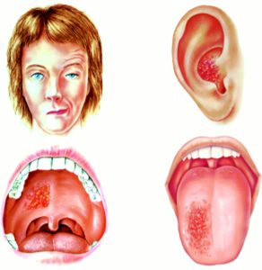 Clinical features of Ramsay Hunt syndrome.