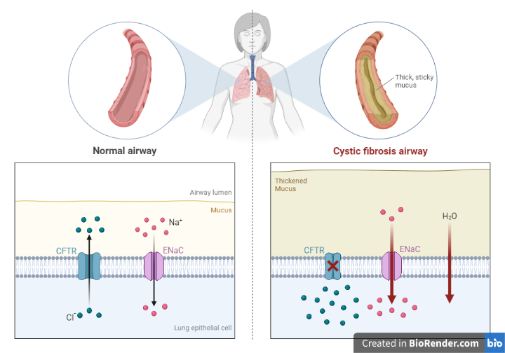 Cystic Fibrosis Airways