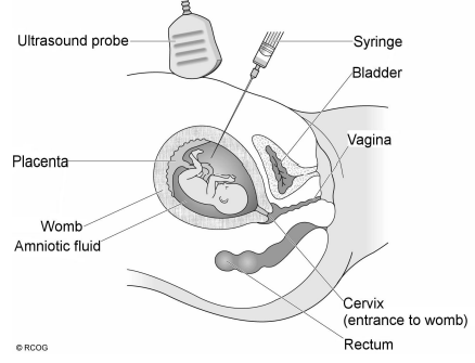 A procedure of amniocentesis