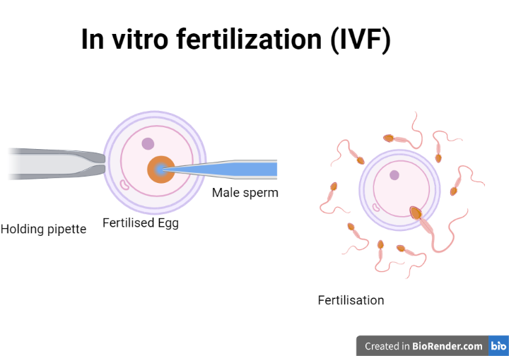 IVF- Definition, Prevalence, Procedure, Risks, Medications - Sciencevivid