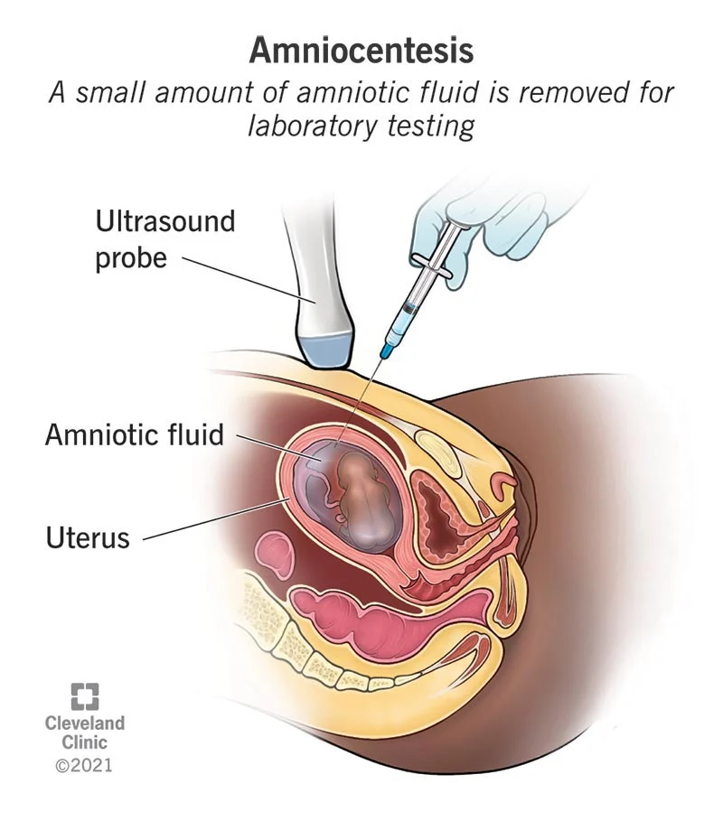 Amniocentesis