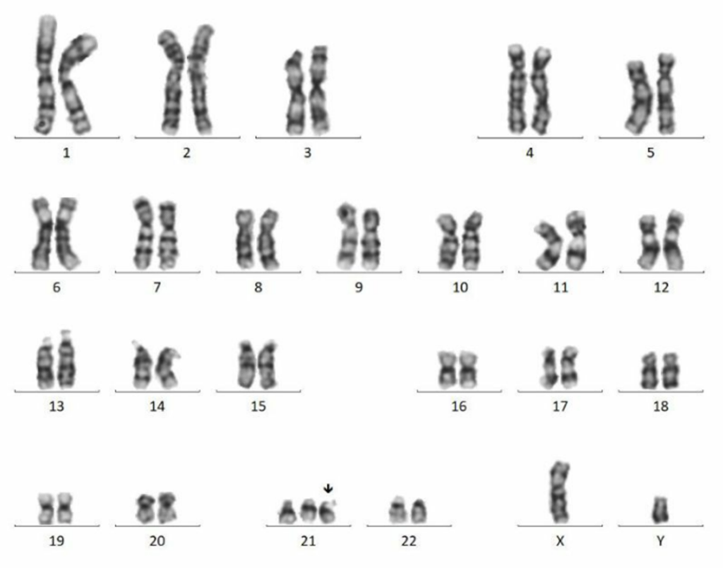 Karyotyping with Trisomy 21