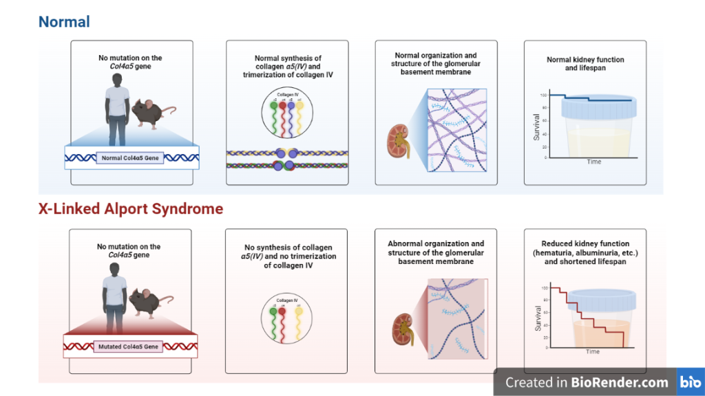  X-Linked Alport Syndrome Pathology