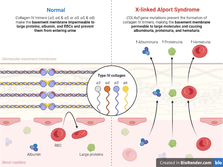 Alport syndrome