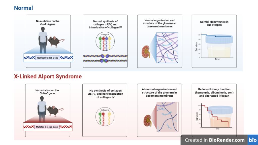 Pathology of Alport syndrome