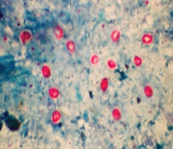 Figure: Round, pink Cryptosporidium parvum oocysts observed under Ziehl–Neelsen staining