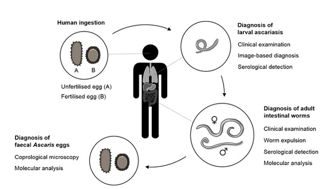 Diagnostic overview of Ascariasis