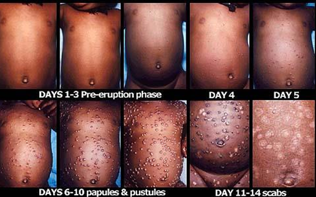 Progression of Small pox infection